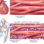 Myocarditis Radang Otot Jantung