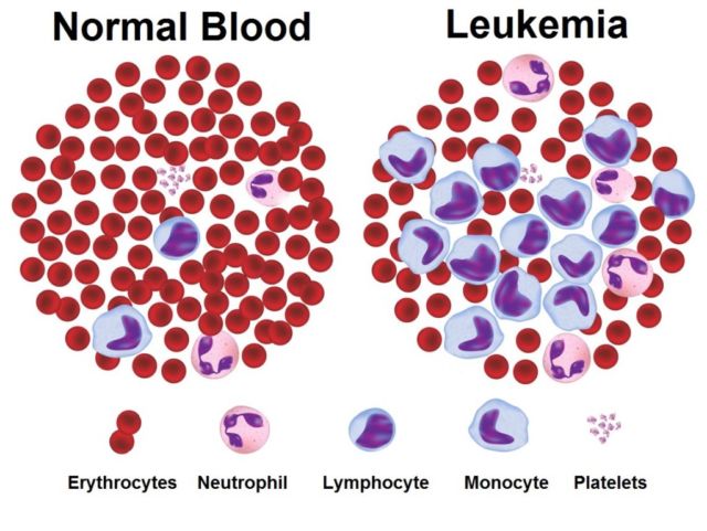 Leukemia Cured With Chlorine Dioxide ?